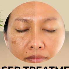 Laser pigmentation treatment
