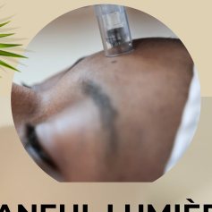 Microneedling treatment